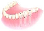 concord dental implants