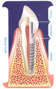 concord dental implants